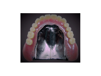 チタン床義歯・チタン床入れ歯