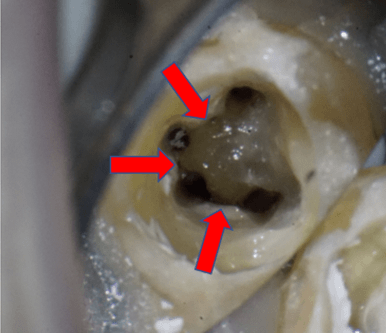 歯の内部構造の複雑な部分を清掃