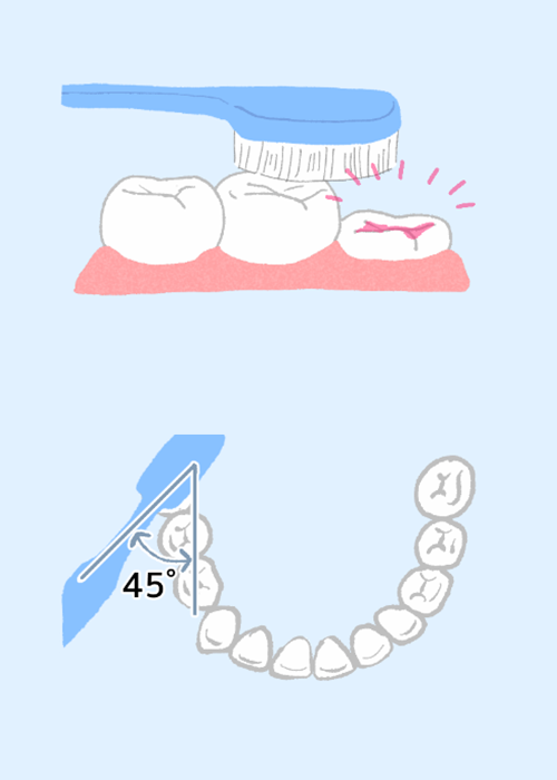 生え始めの背が低い歯